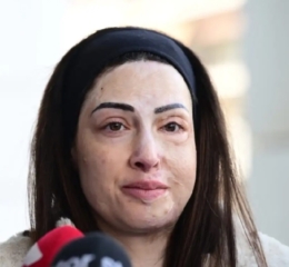 Ιωάννα Παλιοσπύρου για τυχόν αποφυλάκιση της γυναίκας που της έριξε βιτριόλι: Μου προκαλεί σοκ, είναι εγκληματίας